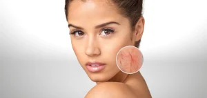 Lazer Kılcal Damar Tedavisi