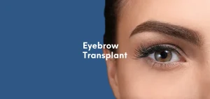 Eyebrow Transplant