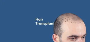 Mikro FUE Hair Transplant