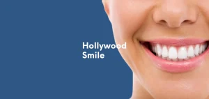 Hollywood Smile